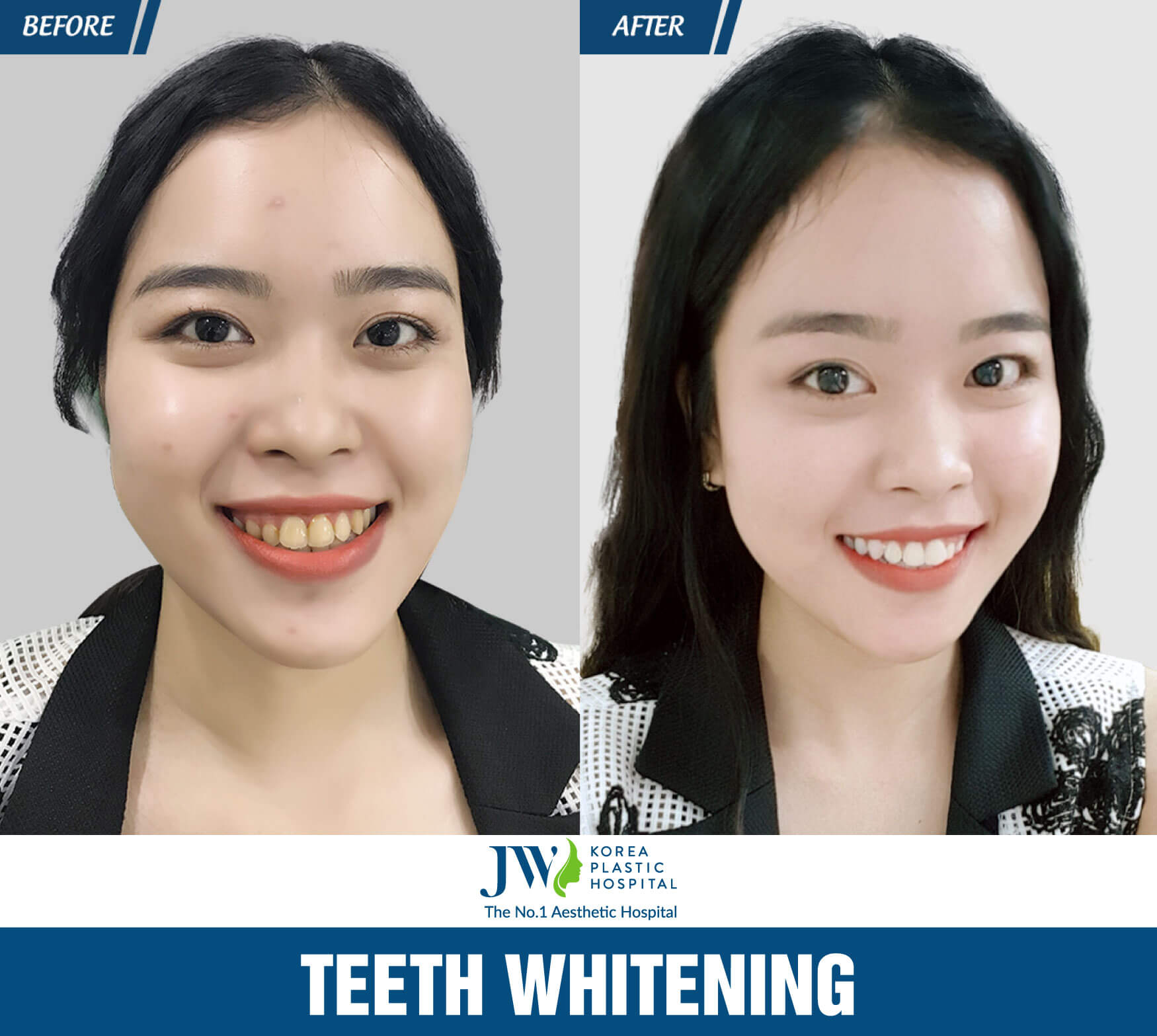 teech-whitening