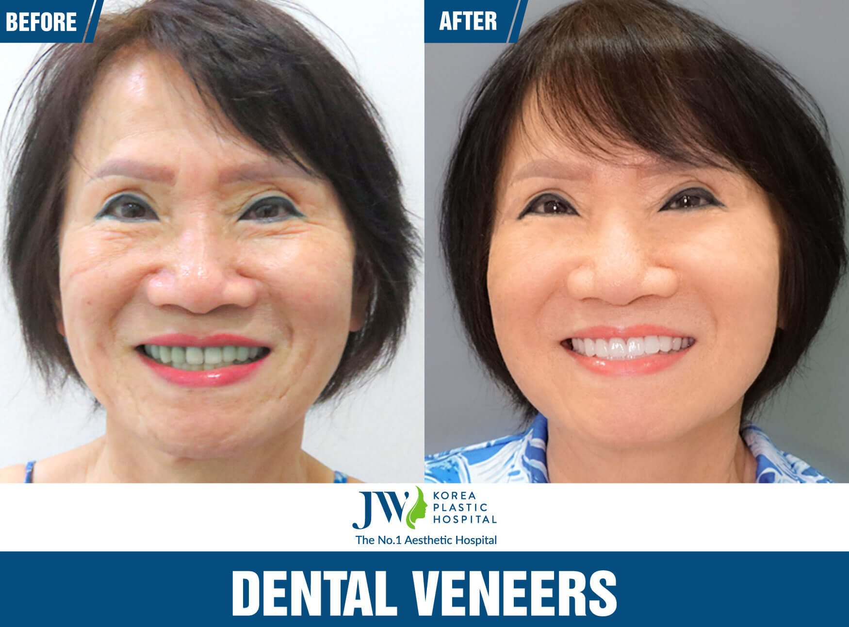 dental-veneers