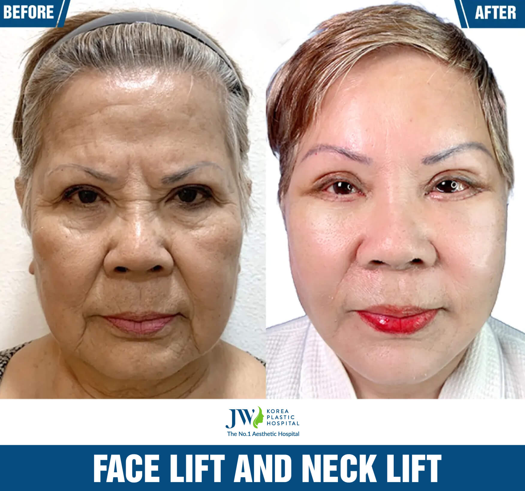 facelift and necklift 