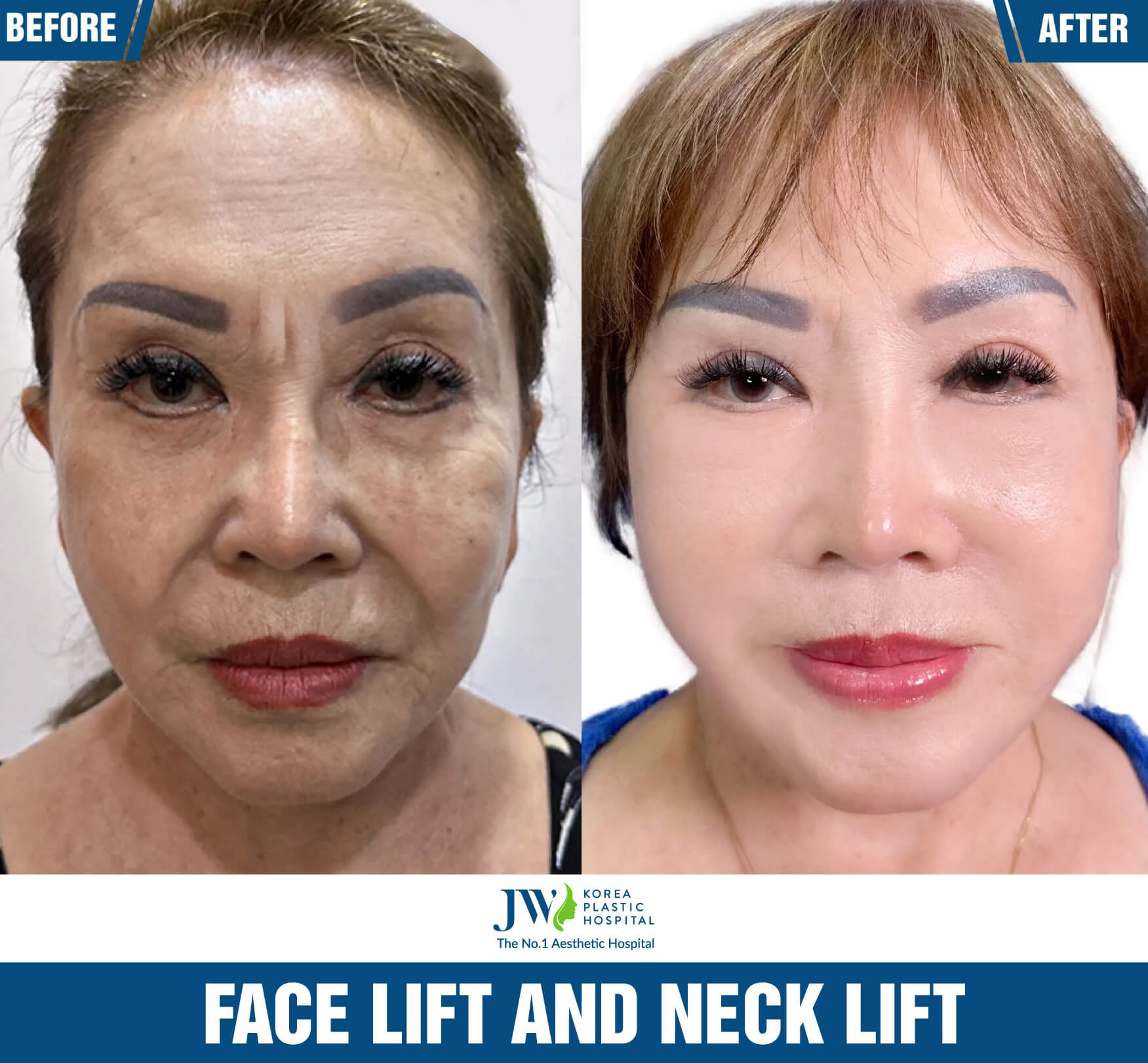 face and necklift 