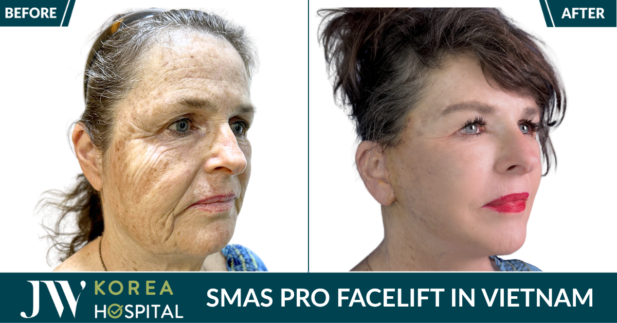 smas pro facelift in Vietnam