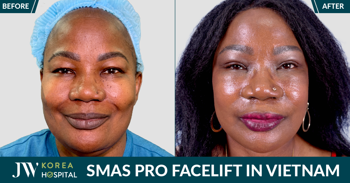 the result before-after smas pro facelift at JW Hospital