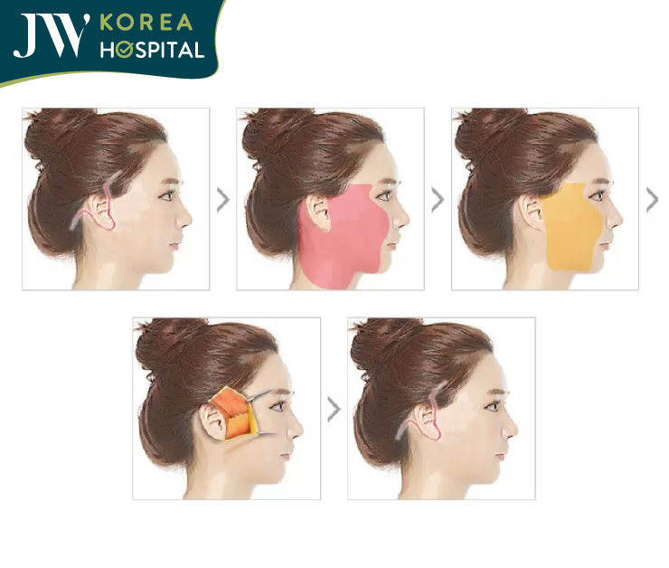 smas pro facelift method JW