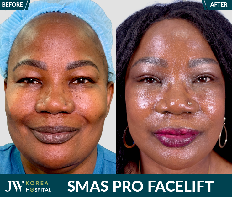 smas pro facelift at JW
