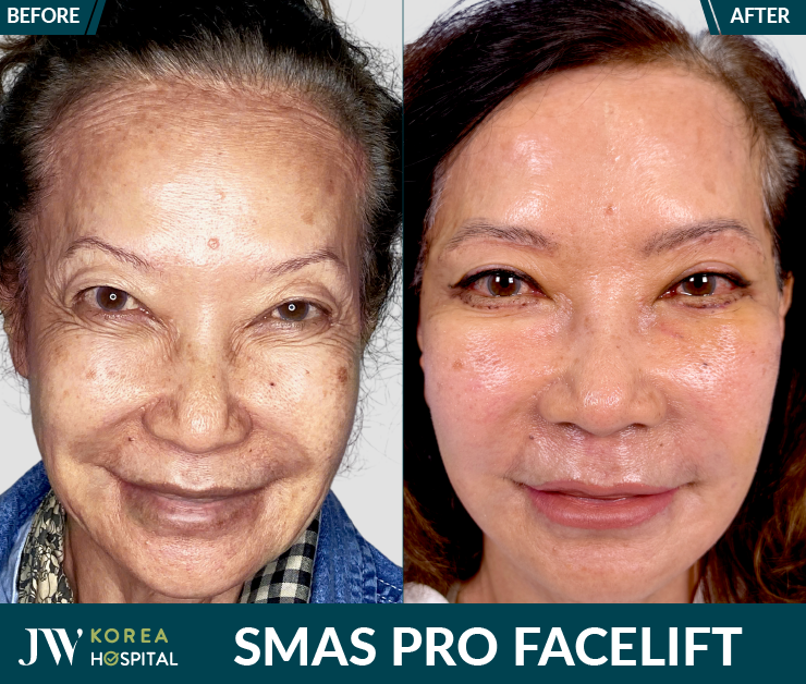 smas pro facelift at JW Hospital