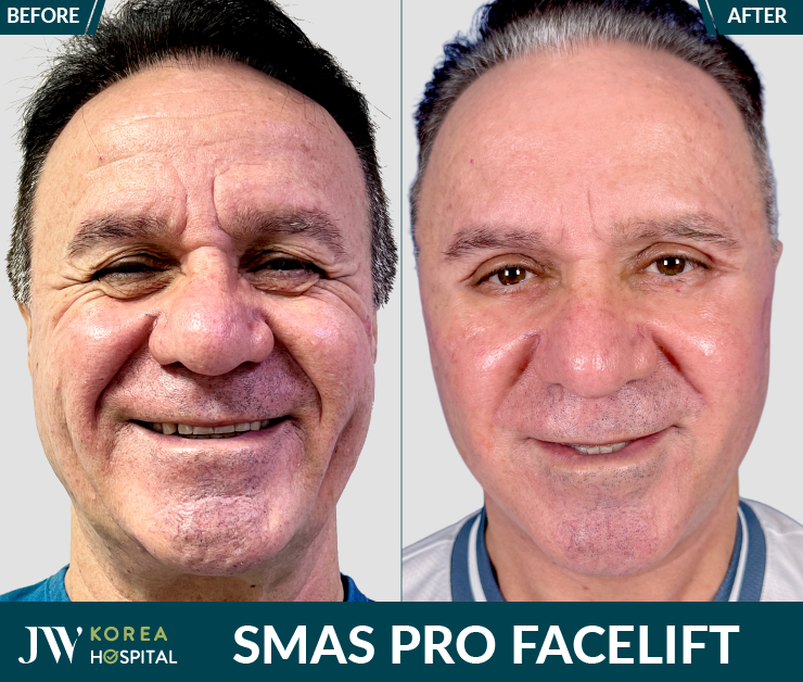 smas pro facelift method at JW