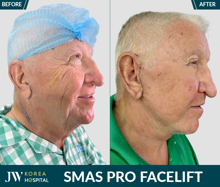 before-after smas pro facelift at JW Hospital