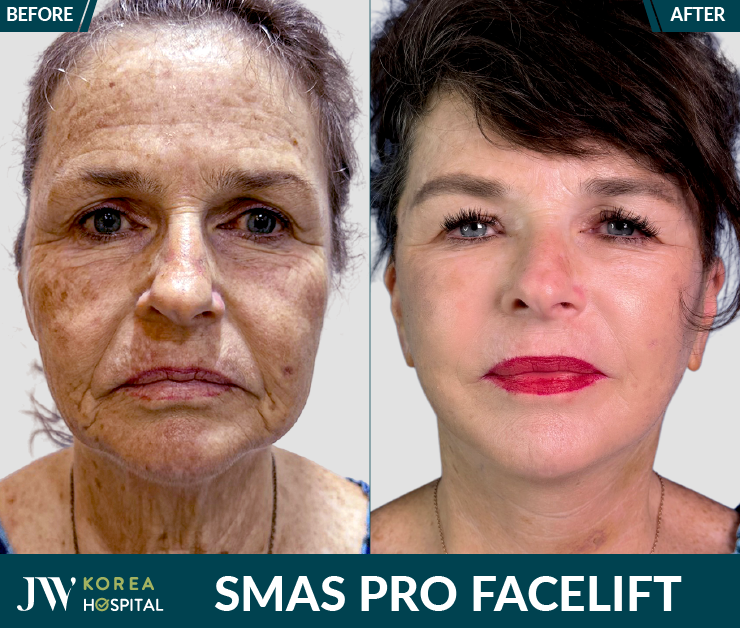the result before-after smas pro facelift at JW