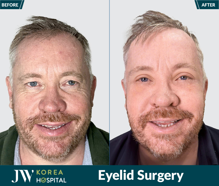 Look 20 years younger after eyelid surgery at JW