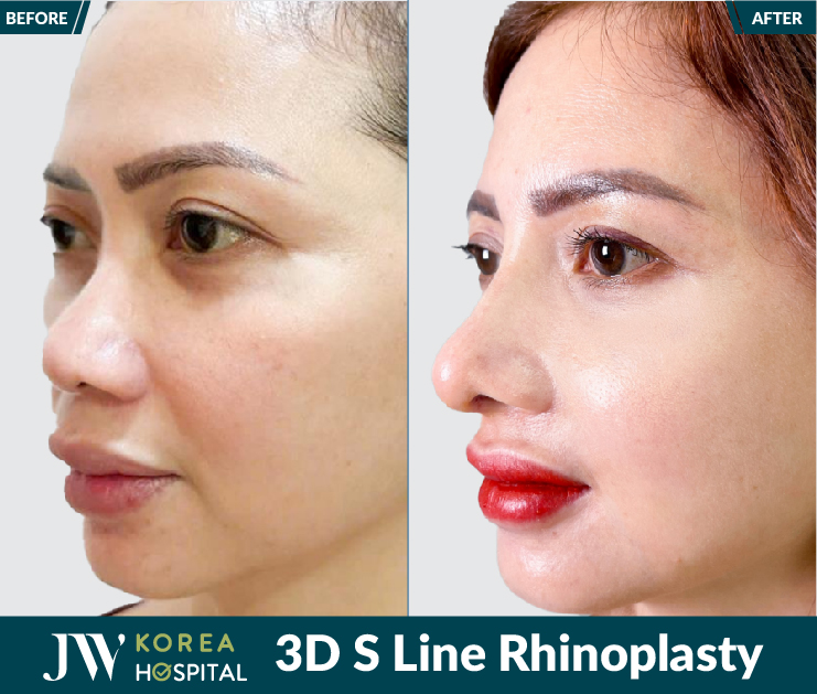 Own a naturally elegant, refined nose after 3D S-Line rhinoplasty at JW